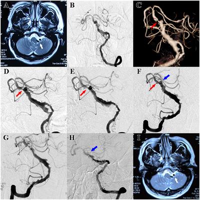 Case report: Late in-stent thrombosis in a patient with vertebrobasilar dolichoectasia after stent-assisted coil embolization due to the discontinuation of antiplatelet therapy